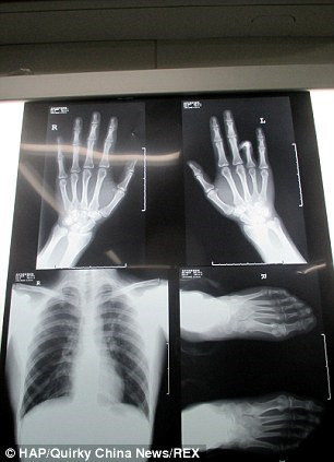 Các bác sỹ phẫu thuật ở tỉnh Hồ Nam, Trung Quốc đã cố gắng tách ngón chân trỏ trái, dùng nó thay thế cho ngón áp úp bị mất của cậu. Bác sỹ Lu, người thực hiện phẫu thuật cho biết: “Rất khó để nhận ra sự khác biệt nếu thoạt nhìn qua. Điểm khác biệt duy nhất đó là kích thước móng”.