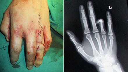 Đây không phải là trường hợp đầu tiên cấy ghép ngón chân vào bàn tay. Hồi tháng 1/2014, một người đàn ông Trung Quốc đã nhờ bác sĩ cấy ghép ngón chân vào bàn tay do lo lợ khó xin việc. Mặc dù việc thiếu một ngón tay không ảnh hưởng gì đến cuộc sống của cậu nhưng Ha Yuan cho rằng việc này khiến cậu khó có thể xin được một công việc lương cao.