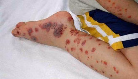 Chikungunya. Sốt chikungunya là bệnh do virus chikungunya lây nhiễm qua trung gian của muỗi truyền bệnh. Bệnh tồn tại trên thế giới từ nhiều thế kỷ, nhưng chỉ mới xuất hiện ở châu Mỹ lần đầu tiên vào cuối năm 2013. Các triệu chứng phổ biến của bệnh này bao gồm đau khớp, nhức đầu, nôn mửa, đau lưng và phát ban da.