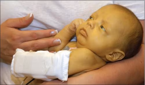 Sốt vàng da: Là một căn bệnh phổ biến ở châu Phi và Nam Mỹ. Đó là một dạng bệnh của sốt xuất huyết không có biện pháp điều trị. Sau một thời gian phát bệnh, hầu hết bệnh nhân điều tự hồi phục. Tuy nhiên, có những trường hợp biến chứng, rối loạn cơ quan có thể dẫn đến tử vong.