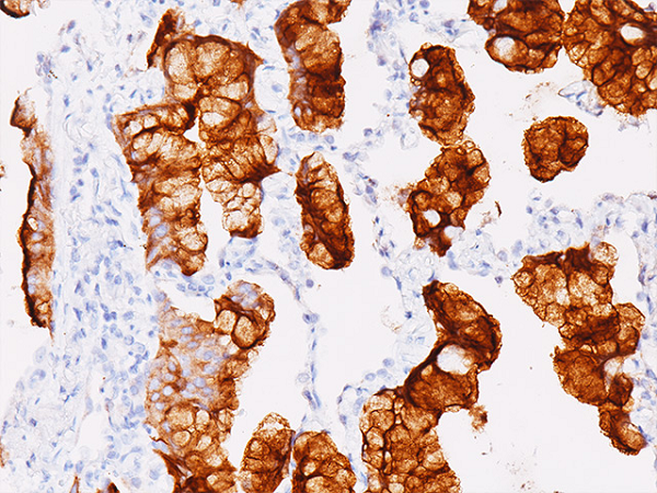 Sinh năm 1997, Jack Andraka đã làm nên tên tuổi trong lĩnh vực y khoa thế giới khi tìm ra phương pháp phát hiện ung thư tuyến tuỵ năm 15 tuổi. Cái chết của một người thân thiết vì ung thư tuyến tuỵ đã thúc đẩy chàng trai trẻ tìm hiểu về các biện pháp phát hiện ung thư sớm.