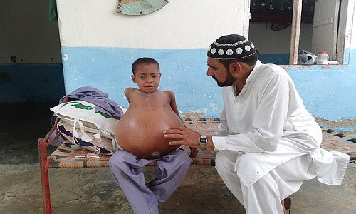 Xot xa cau be 9 tuoi bung to gap 3 lan qua bong