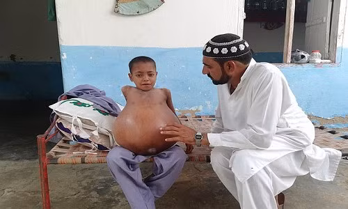 Xot xa cau be 9 tuoi bung to gap 3 lan qua bong