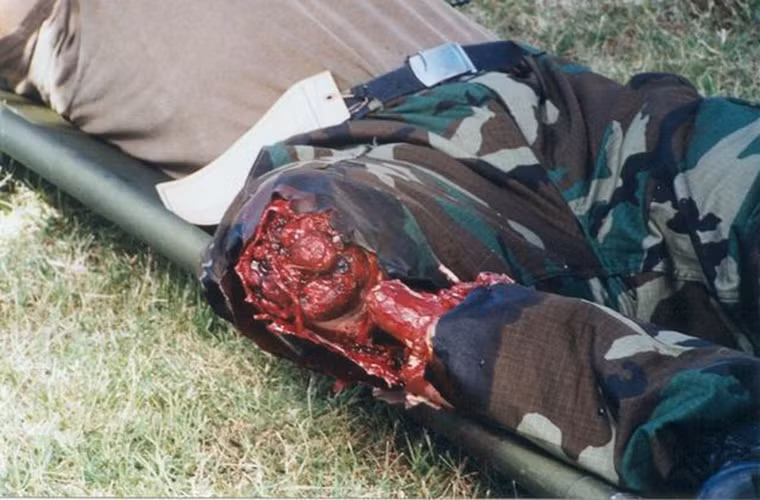 Công nghệ MOULAGE giúp các bác sĩ quân y Mỹ làm quen với mọi tình huống có thể xảy ra đối với một binh sĩ trên trường với một tâm lý vững vàng hơn. Trong ảnh là một binh sĩ được hóa trang với công nghệ MOULAGE cùng cái chân giả gần như đứt lìa của mình.