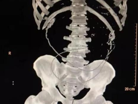 Thung ruot, nguy kich tinh mang vi nuot 2 con luon de chua tao bon