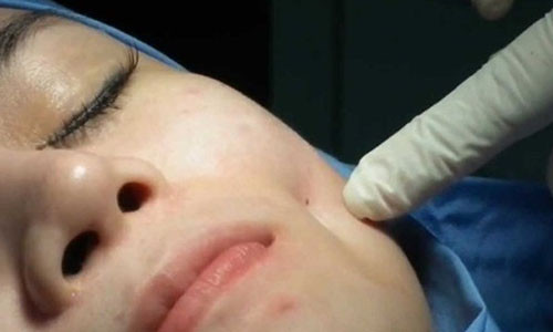 Bác sĩ sẽ thực hiện một mũi khâu đính dính phần cơ má và da với nhau để khi mặt hoạt động sẽ tạo nên hiện tượng co rút vào trong, tạo má lúm đẹp tự nhiên, rõ ràng không lộ sẹo phía bên ngoài.