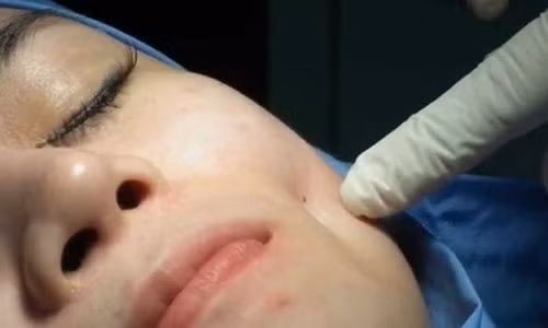 Bác sĩ sẽ thực hiện một mũi khâu đính dính phần cơ má và da với nhau để khi mặt hoạt động sẽ tạo nên hiện tượng co rút vào trong, tạo má lúm đẹp tự nhiên, rõ ràng không lộ sẹo phía bên ngoài.