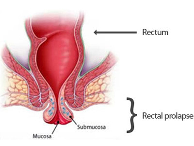 Sa trực tràng do ngại đi đại tiện. Nhịn đi đại tiện là một trong những nguyên nhân dẫn đến bệnh sa trực tràng (lòi ruột). Khi phân xuống, trực tràng sẽ kích thích việc đi ngoài. Việc nhịn làm trực tràng có thói quen giữ phân, không còn kích thích như trước dẫn đến bệnh sa trực tràng.