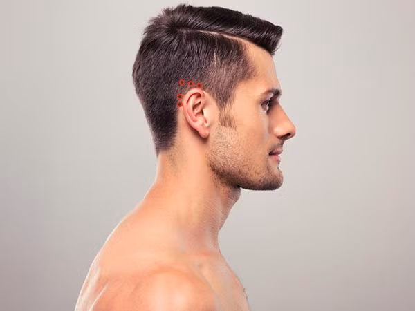 Tai. Có khoảng 5 huyệt xung quanh vành tai như hình ảnh. Sử dụng tất cả 5 ngón tay của bạn ấn nhẹ lên 5 điểm cùng lúc để giảm đau nhanh nhất.