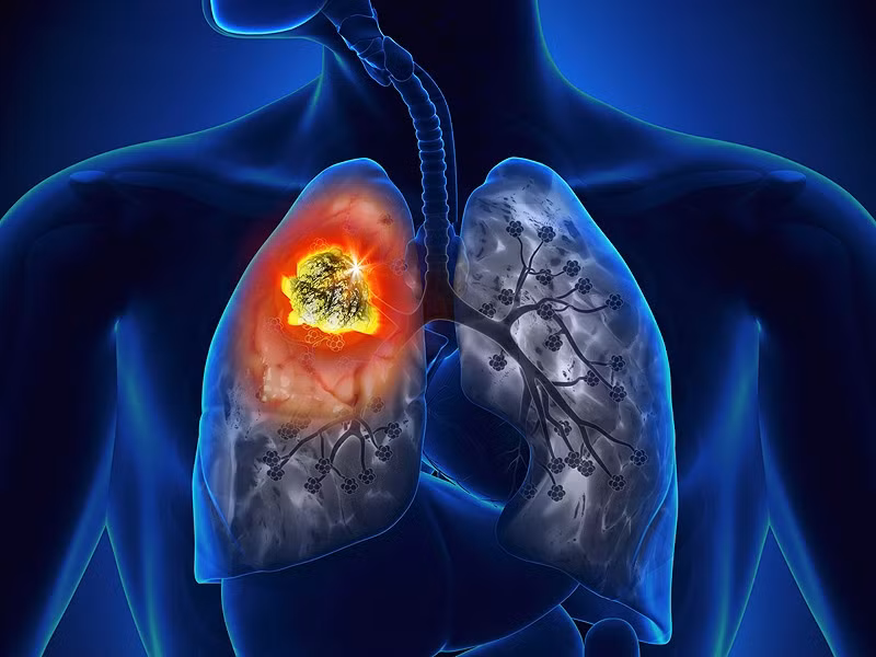 Ung thư phổi xếp hàng thứ nhất trong 10 loại ung thư thường gặp, là nguyên nhân gây tử vong hàng đầu tại VN.