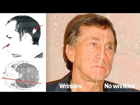 Dù lúc đầu Bugorski có vẻ vẫn ổn, tuy nhiên chùm tia siêu mạnh này khiến nửa trái đầu của ông mất kiểm soát và một phần da bong tróc tại vị trí chùm tia chiếu vào và đi ra từ sọ ông. Nó cũng gây bỏng theo một đường thẳng xuyên qua não Bugorski, dù ông không bị suy giảm trí tuệ.