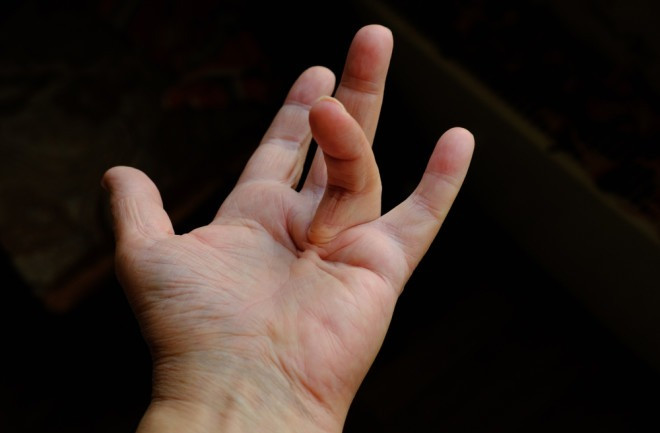 Tiếp theo, họ so sánh các biến thể gen này với bộ gen của người Neanderthal đã được giải trình tự trước đó. Họ bất ngờ phát hiện ra rằng, trong số 61 biến thể này, ba biến thể có nguồn gốc từ người Neanderthal, trong đó có hai biến thể có mối liên hệ rất chặt chẽ với căn bệnh này. Gen của người Neanderthal liên quan đến căn bệnh này, được gọi là EPDR1, nằm trên nhiễm sắc thể số 7.