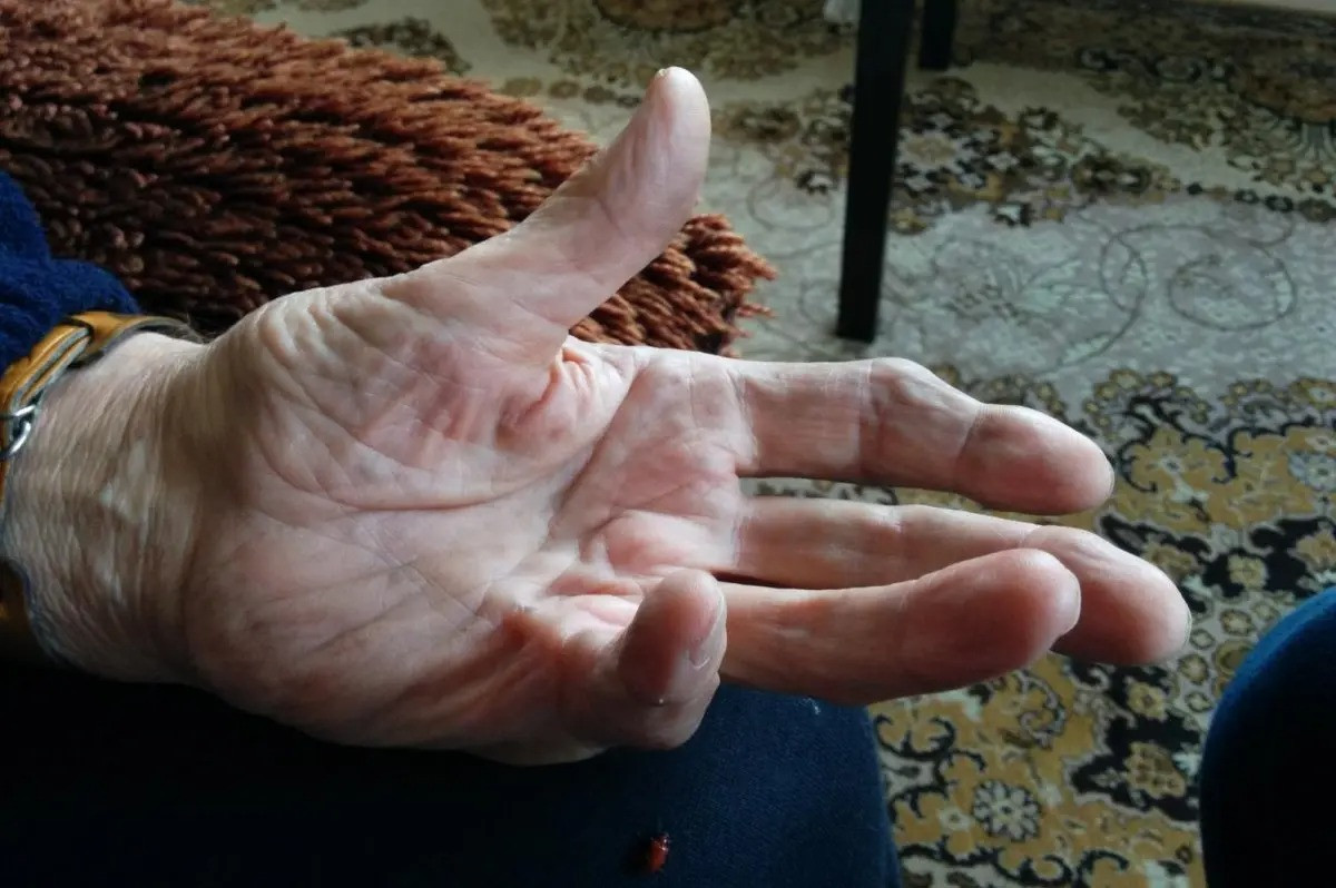 Nghiên cứu mới có ý nghĩa rất lớn đối với liệu pháp xạ trị trong tương lai, Zeberg nói. Trong các bước tiếp theo, Zeberg hy vọng sẽ thực hiện nhiều nghiên cứu định hướng lâm sàng hơn về căn bệnh này. Việc tìm kiếm các bệnh khác gắn liền với DNA còn sót lại của người Denisovan, người anh em họ ở Đông Âu của người Neanderthal, cũng nằm trong nghiên cứu. hlj;