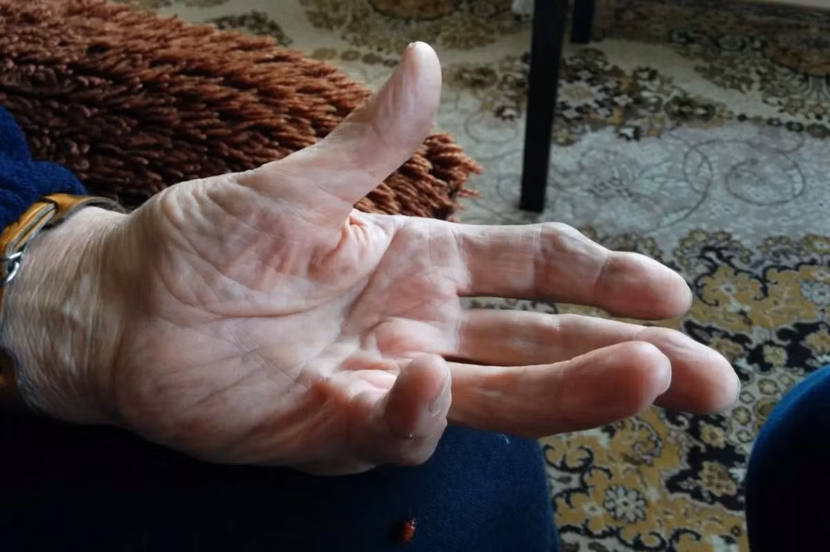 Nghiên cứu mới có ý nghĩa rất lớn đối với liệu pháp xạ trị trong tương lai, Zeberg nói. Trong các bước tiếp theo, Zeberg hy vọng sẽ thực hiện nhiều nghiên cứu định hướng lâm sàng hơn về căn bệnh này. Việc tìm kiếm các bệnh khác gắn liền với DNA còn sót lại của người Denisovan, người anh em họ ở Đông Âu của người Neanderthal, cũng nằm trong nghiên cứu. hlj;