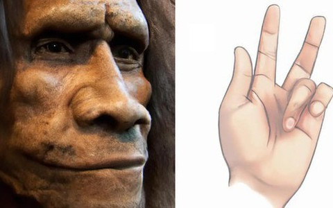 Bệnh Dupuytren là một rối loạn làm tê liệt bàn tay được đặt theo tên của một bác sĩ phẫu thuật người Pháp, trong đó các ngón tay, điển hình là ngón đeo nhẫn và ngón út, bị khóa vĩnh viễn ở tư thế cong.