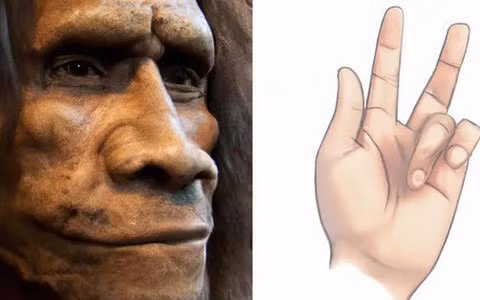 Bệnh Dupuytren là một rối loạn làm tê liệt bàn tay được đặt theo tên của một bác sĩ phẫu thuật người Pháp, trong đó các ngón tay, điển hình là ngón đeo nhẫn và ngón út, bị khóa vĩnh viễn ở tư thế cong.