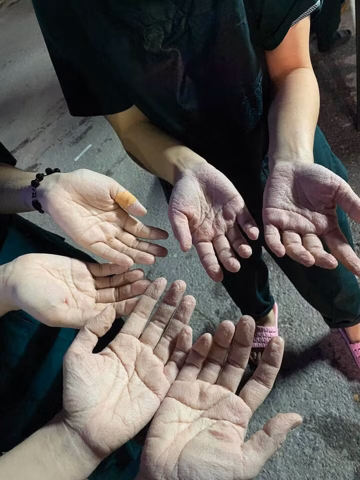 Giữa cái nóng oi bức 39-40 độ, các nhân viên y tế, các tình nguyện viên vẫn phải mặc đồ bảo hộ 24/24 để làm nhiệm vụ. "Ngâm" trong mồ hôi quá lâu khiến đôi bàn tay, bàn chân họ đau rát, nhăn nheo, trắng bệch.