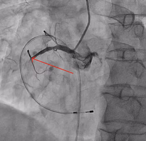 Mot benh nhan bi tac hoan toan dong mach vanh duoc cuu song