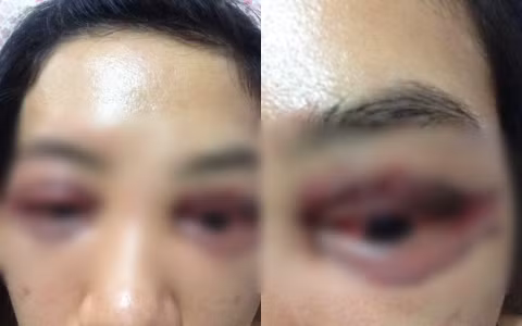 Hình ảnh chị Lan Anh bị cắt mí mắt hỏng trước đó.