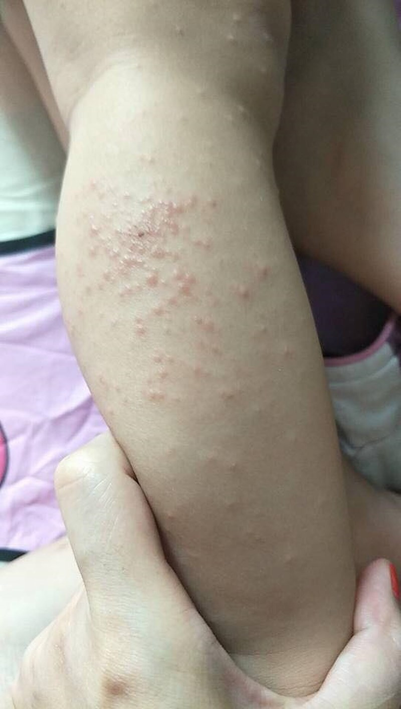 Trẻ em bị mẩn ngứa sau khi tắm nước mấy ngày gần đây. Ảnh: người dân cung cấp