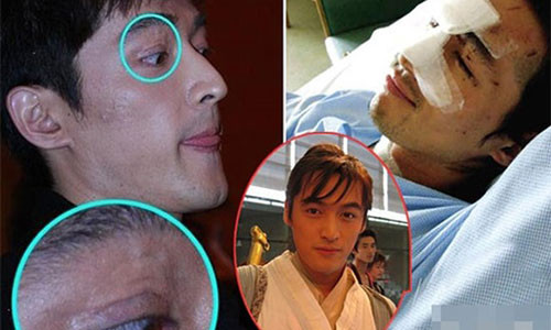 Vụ tai nạn để lại nhiều vết sẹo trên gương mặt Hồ Ca.