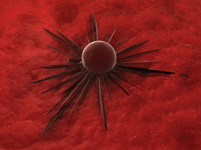 Tu kham ban than: Nguoi co 5 dac diem nay, de bi ung thu tan cong-Hinh-5