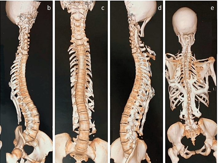4. Hội chứng “Người đá” (Fibrodysplasia Ossificans Progressiva): Đây là một bệnh di truyền hiếm gặp khiến các mô mềm trong cơ thể dần dần biến thành xương. Người mắc bệnh này dần dần mất khả năng di chuyển và cuối cùng có thể bị “đóng băng” trong một tư thế cố định. (Ảnh:MDPI)