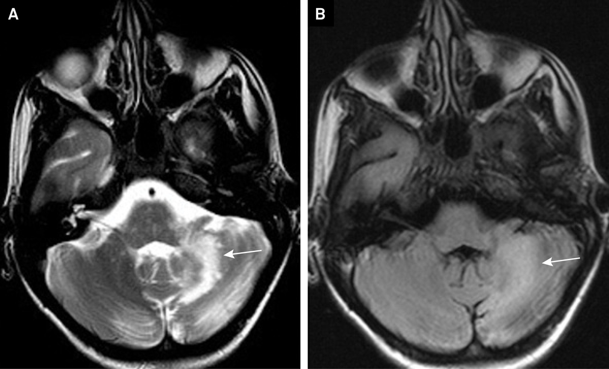 Căn bệnh “mất điều hòa tiểu não” (cerebellar ataxia) là một rối loạn ảnh hưởng đến tiểu não, phần của não bộ chịu trách nhiệm điều phối các chuyển động và duy trì sự cân bằng. Khi tiểu não bị tổn thương hoặc không hoạt động đúng cách, người bệnh sẽ gặp khó khăn trong việc điều khiển các chuyển động của cơ thể. (Ảnh: Arquivos de Neuro-Psiquiatria)