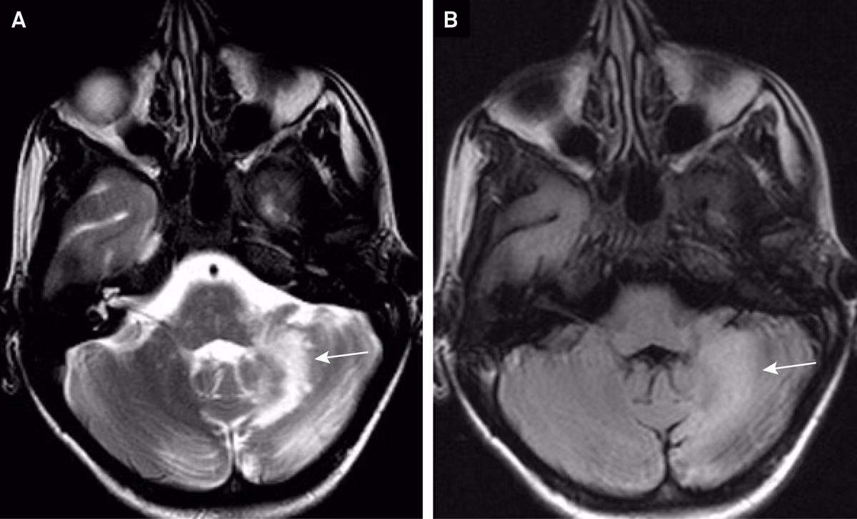 Căn bệnh “mất điều hòa tiểu não” (cerebellar ataxia) là một rối loạn ảnh hưởng đến tiểu não, phần của não bộ chịu trách nhiệm điều phối các chuyển động và duy trì sự cân bằng. Khi tiểu não bị tổn thương hoặc không hoạt động đúng cách, người bệnh sẽ gặp khó khăn trong việc điều khiển các chuyển động của cơ thể. (Ảnh: Arquivos de Neuro-Psiquiatria)