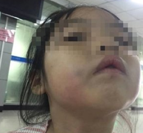 DUNG TRUC ____ Co giao dung thuoc danh vao mat be gai 5 tuoi suot 8 phut, loi bao chua cua nha truong gay phan no