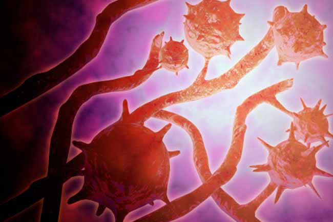 Thường xuyên bị nhiễm khuẩn: Ung thư máu có thể làm suy giảm chức năng kháng khuẩn của các tế bào bạch cầu. Sự suy giảm tế bào máu khiến người bệnh thường xuyên bị nhiễm vi khuẩn, virus hoặc nấm.