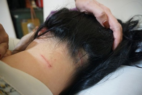 Qua giám định, chị Trang có kết quả đa chấn thương, chấn động não, tổn hại sức khỏe 12%.