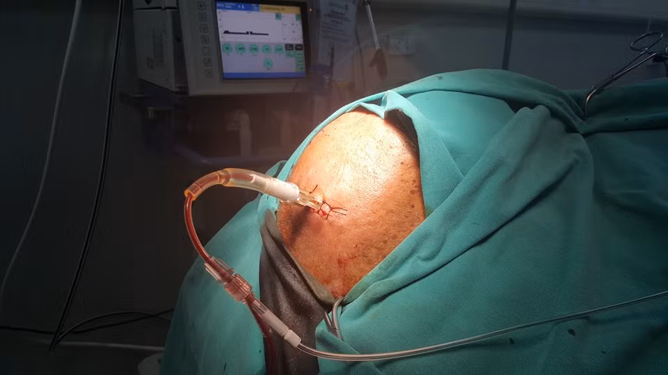 Can canh ky thuat khoan so nao benh nhan-Hinh-2