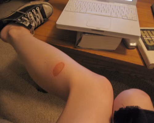 Nếu chọn điều trị các vết bỏng bằng cây hoa mười giờ, các vết bỏng nhẹ, bỏng nông sẽ khô, không bị phồng, rát, lên da non và mau lành. Tuy nhiên, các vết bỏng sâu thì nên tới cơ sở y tế để chữa.