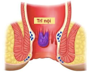 Bên cạnh bài thuốc trên, rau cóc chữa các chứng trĩ, cả trĩ nội lẫn trĩ ngoại. Người mắc bệnh trĩ có thể dùng rau cóc theo nhiều cách như nấu canh, ăn sống hoặc xay nhỏ để đắp trực tiếp làm dễ tiêu hóa, giảm trĩ.