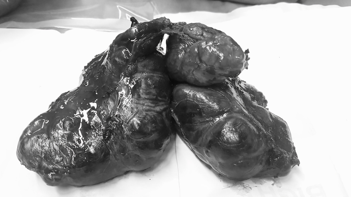 Cắt bướu giáp khổng lồ cho bệnh nhân mắc basedow 12 năm - Hình 3 Cat buou giap khong lo cho benh nhan mac basedow 12 nam-Hinh-3