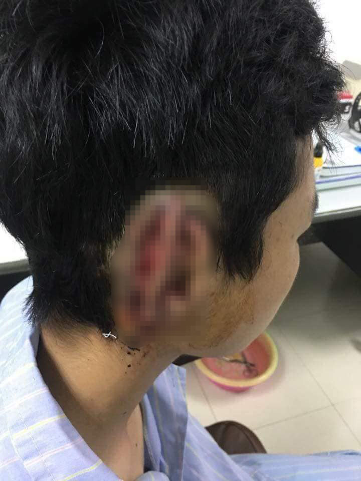 Hy huu: Noi lai tai cho nam sinh bi ban can dut roi nuot vao bung