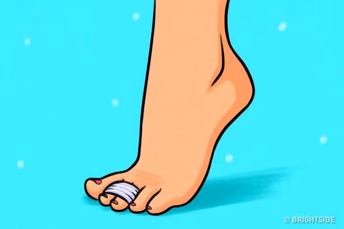 Băng các ngón chân của bạn: Bạn có thể dán từng ngón chân lại để giảm áp lực cho dây thần kinh giữa hai ngón chân gây đau.