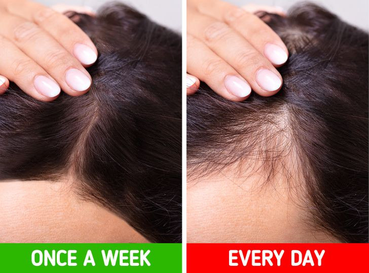 Khiến tóc rụng: Rụng tóc do kéo tóc (traction alopecia) là tình trạng rụng tóc thường xảy ra ở đường chân tóc ở vùng trán và thái dương, quanh tai... Nguyên nhân là bởi tóc bị kéo lâu ngày do buộc chặt. Ảnh: BS.
