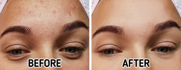 Dưa bắp cải muối chứa nhiều chất xơ và lợi khuẩn, giúp giảm đầy hơi, làm phẳng bụng, đồng thời, làm sạch da, giảm mụn trứng cá. Dưa bắp cải còn giúp tăng khả năng hấp thu vitamin và khoáng chất, tăng nguồn năng lượng cho cơ thể mà không gây tăng cân.