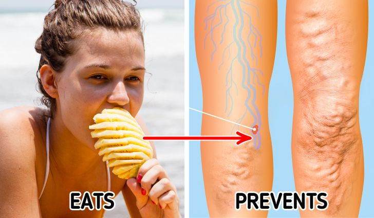 Dứa chứa nhiều bromelain, giúp phân hủy protein và tiêu hóa chúng, đồng thời, hỗ trợ đốt cháy chất béo. Thường xuyên ăn dứa giúp giảm cholesterol, ngăn ngừa xơ vữa, tắc nghẽn động mạch.