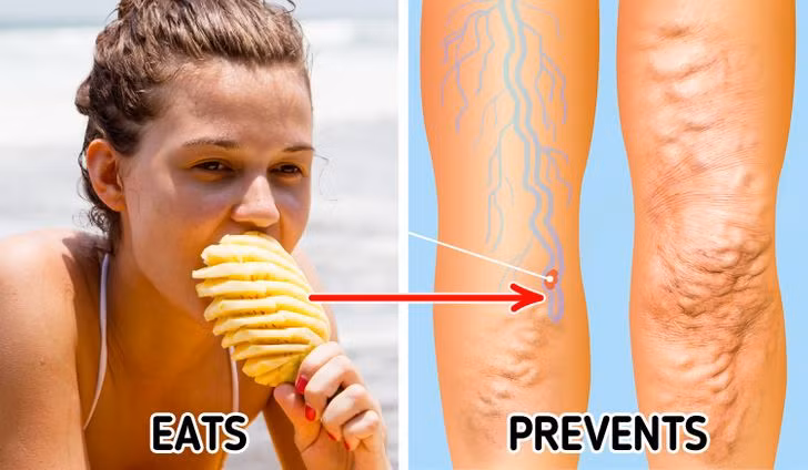 Dứa chứa nhiều bromelain, giúp phân hủy protein và tiêu hóa chúng, đồng thời, hỗ trợ đốt cháy chất béo. Thường xuyên ăn dứa giúp giảm cholesterol, ngăn ngừa xơ vữa, tắc nghẽn động mạch.