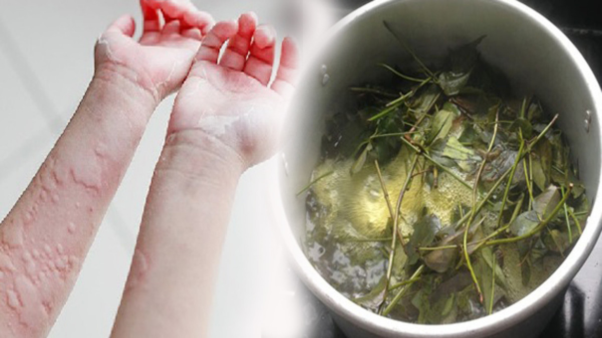 Loại lá tắm này có thành phần hoạt chất khi đi qua da sẽ có tác dụng đẩy lùi cơn ngứa ngáy hiệu quả. Với khả năng kháng khuẩn tốt, loại lá này còn có tác dụng ức chế và ngăn chặn sự phát triển của vi khuẩn gây hại trên da. Trong quá trình tắm nên lấy bã lá khế chà xát nhẹ lên vị trí mẩn đỏ, ngứa ngáy trên da.