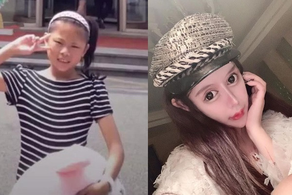 Rich kid Tiểu Z Na Na (tên thật Châu Sở Na) nổi tiếng mạng xã hội Trung Quốc với biệt danh "hot girl phẫu thuật thẩm mỹ". Do nghiện phẫu thuật thẩm mỹ, cô nàng này giờ đây chịu nhiều vấn đề sức khỏe như bị mỏng giác mạc, suy giảm trí nhớ.