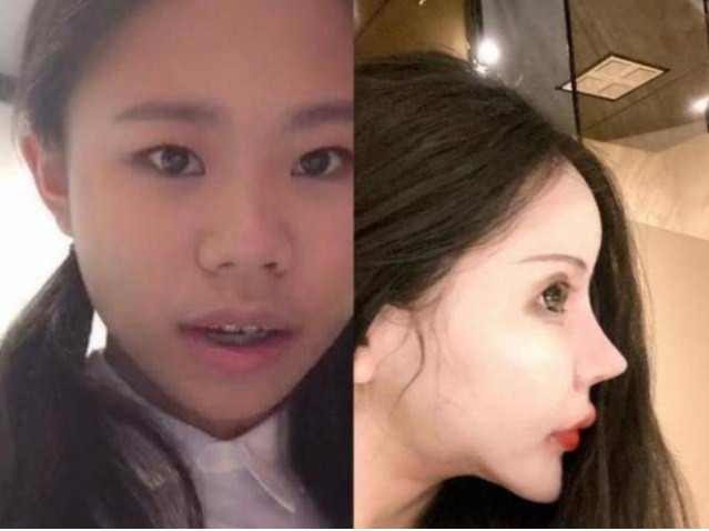 Năm 13 tuổi, Tiểu Z năn nỉ mẹ mình cho đi phẫu thuật mắt hai mí. Dù cha mẹ cô không ủng hộ việc con đụng dao kéo khi còn quá nhỏ, cô nói rằng mình sẽ "trưởng thành thuận lợi hơn sau khi thẩm mỹ" và không thay đổi quyết định của mình.