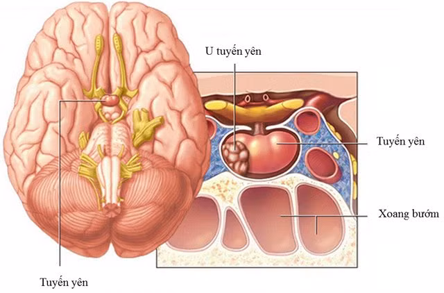 Benh u tuyen yen ca si Anh Tuyet mac nguy hiem the nao?-Hinh-2