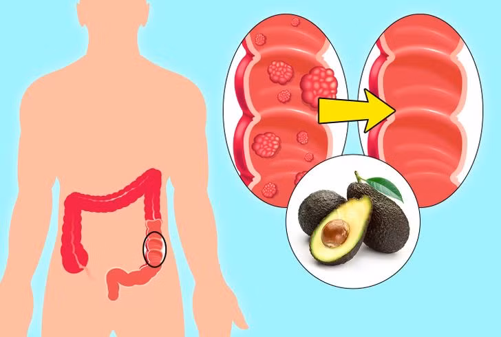 8. Ngăn ngừa ung thư: Quả bơ có khả năng tiêu diệt các tế bào gây ung thư và ngăn ngừa bệnh này phát triển.