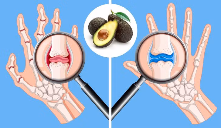 10. Giúp làm giảm các triệu chứng của bệnh viêm khớp: Những người bị viêm khớp thường phải đối mặt với những cơn đau khớp, nhưng ăn bơ có thể giúp họ giảm đau. Trái cây có đặc tính chống oxy hóa và giảm đau hiệu quả.