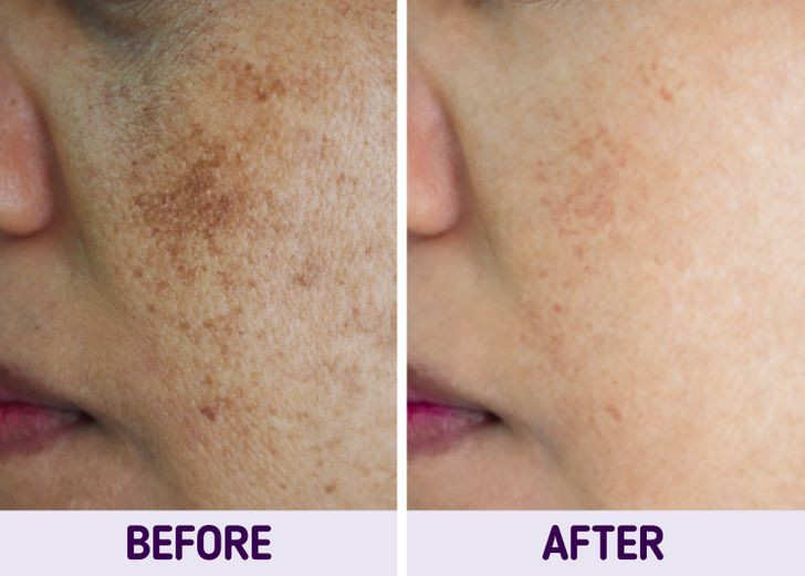 10. Tiêu thụ amla (quả me rừng) sau bữa ăn: Một mẹo trị nám nữa từ các bác sĩ là hãy bắt đầu ăn quả amla. Bạn có thể mua nó dưới dạng bột và uống 1 thìa cà phê 2 lần một ngày. Nhưng tốt hơn hết bạn nên tiêu thụ nó sau bữa ăn khoảng 30-40 phút. Ảnh: BS.