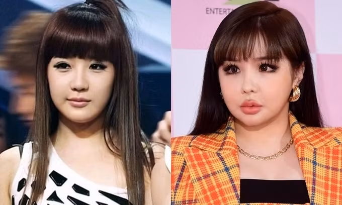 Park Bom: Vướng không ít các nghi án thẩm mỹ, nhưng Park Bom chưa từng một lần lên tiếng thừa nhận đụng chạm "dao kéo". Tuy nhiên, những hình ảnh ngày ấy – bây giờ của cựu thành viên 2NE1 lại chứng minh điều ngược lại. Biến chứng từ phẫu thuật thẩm mỹ khiến việc cử động khuôn mặt của nữ ca sĩ tương đối khó khăn. Ảnh: Internet.